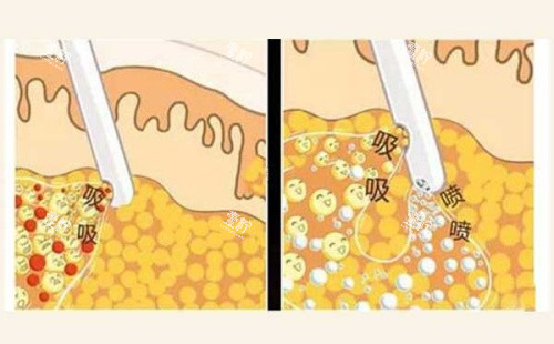 吸脂操作示意图