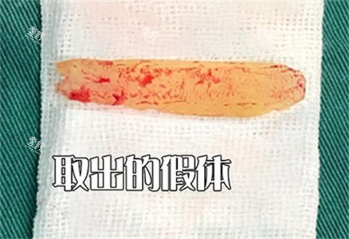 鼻假体取出改善图照片