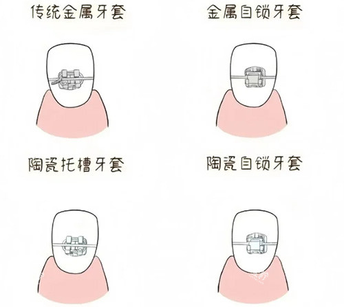 牙套品牌种类示意图