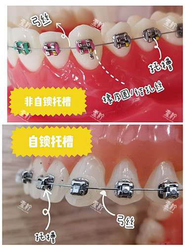 牙齿矫正自锁和非自锁牙套区别