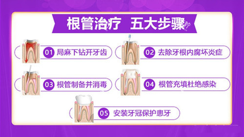 根管治疗的步骤