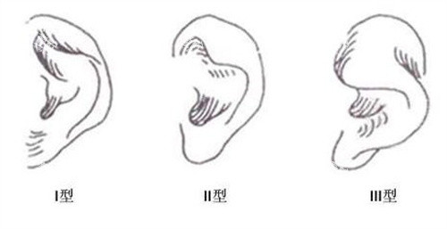 小耳畸形的类型