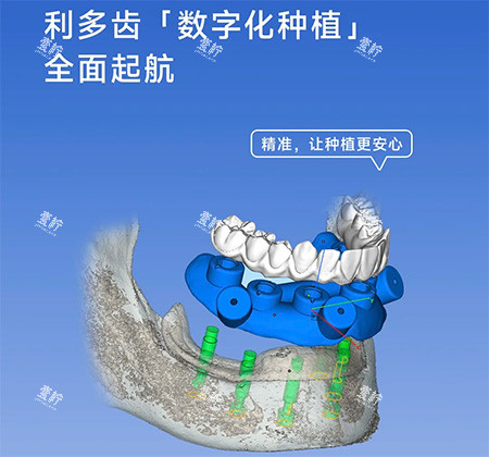 利多齿种植牙怎么样