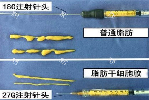 自体脂肪填充需要的脂肪提纯后的样子图片