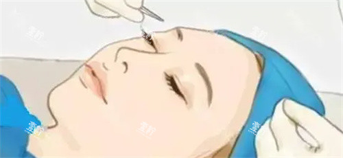 双眼皮手术过程卡通图