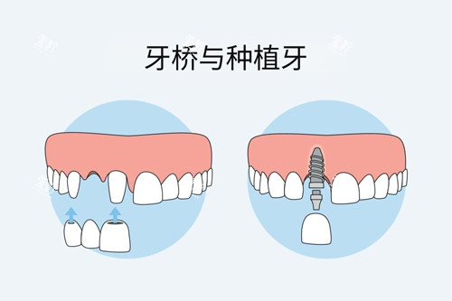 国产种植牙崛起！卡尔斯植体凭什么成“黑马”？