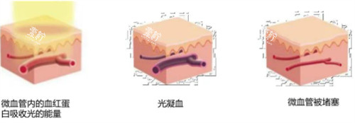 595染料激光治疗过程图解