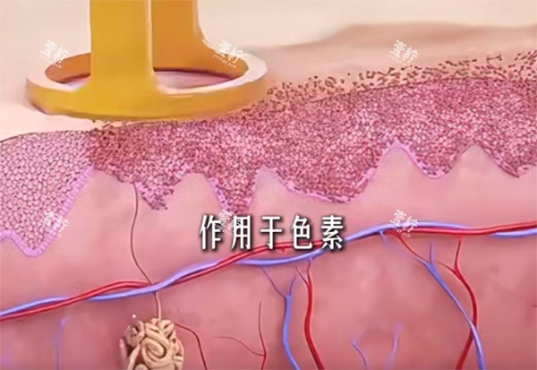 调Q激光手术示意图