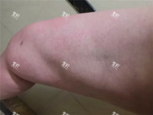 北京润美玉之光吸脂凹凸不平修复全解析：技术、价格、真实反馈一次说清