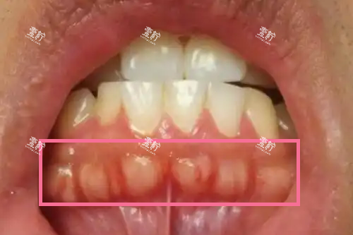 牙槽骨增生.webp