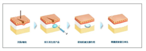 童颜针注射前后对比图解