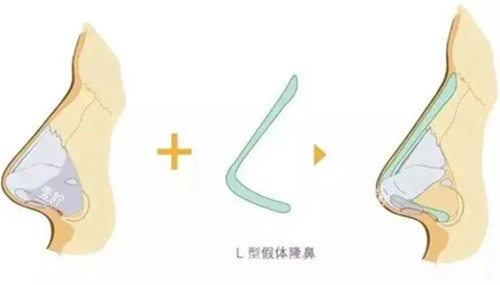 L型假体隆鼻步骤示意图
