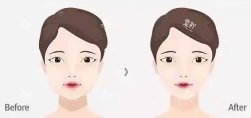 面部轮廓整形前后对比图