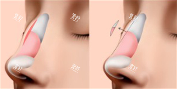 北京隆鼻修复选哪家？奥尔贝德10年老牌机构揭秘，真实术例太惊艳！