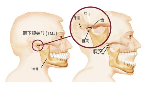 颞下颌关节紊乱示意图