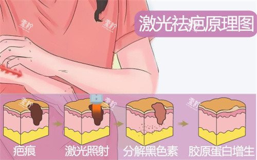 武汉激光祛疤可以淡化到什么程度？这些疤痕类型淡化还不错！