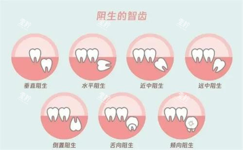 阻生智齿的示意图