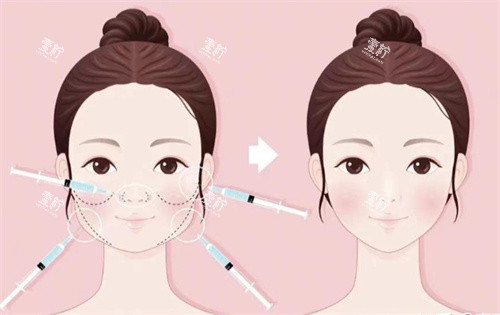 针剂注射打造幼态脸 针剂注射打造幼态脸