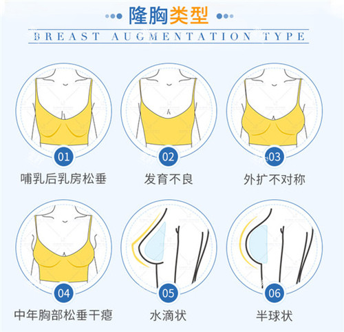 假体隆胸适应症 假体隆胸适应症