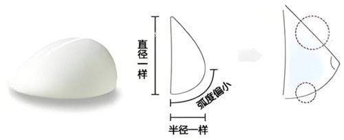 假体隆胸水滴形 假体隆胸水滴形