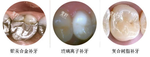 补牙材料示意图
