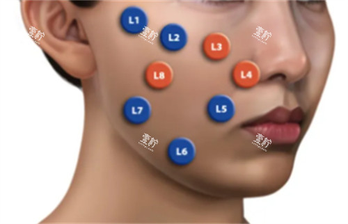 乔雅登不同点位注射方法