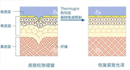 热玛吉作用在皮肤上皮下组织展示 热玛吉作用在皮肤上皮下组织展示