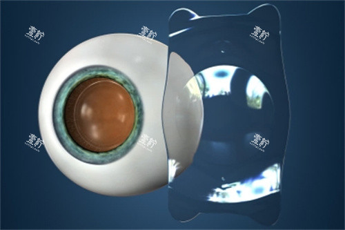 眼睛植入ICL晶体 眼睛植入ICL晶体