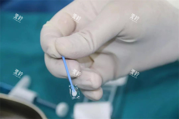 近视手术选晶体植入还是飞秒?这3类人选对方法结果翻倍!