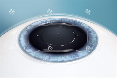 ICLV5晶体植入后的位置 ICLV5晶体植入后的位置