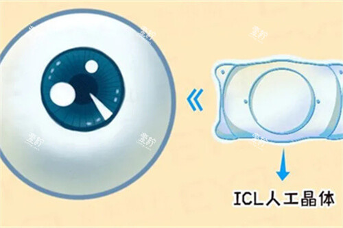icl人工晶体与眼球漫画图 icl人工晶体与眼球漫画图