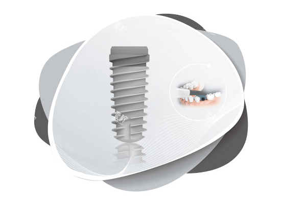 大清西格种植牙照片图 大清西格种植牙照片图