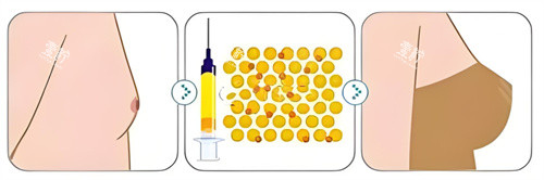 自体脂肪隆胸对比 自体脂肪隆胸对比