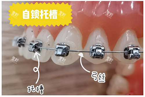 牙齿矫正自锁托槽牙套 牙齿矫正自锁托槽牙套