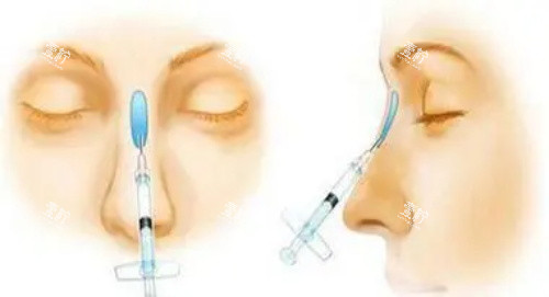 玻尿酸注射隆鼻示意图