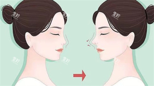 想找汪军华做鼻修复？先看这篇：结果、价格、风险一次说清！