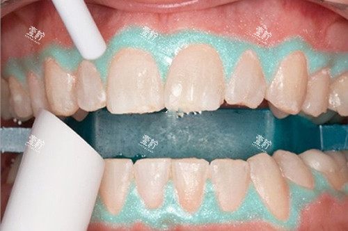 牙齿美白照灯模型示意图