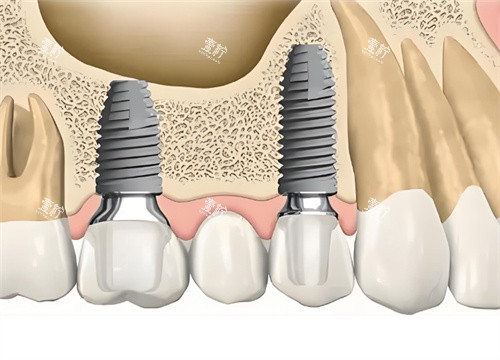 种植牙解剖图片