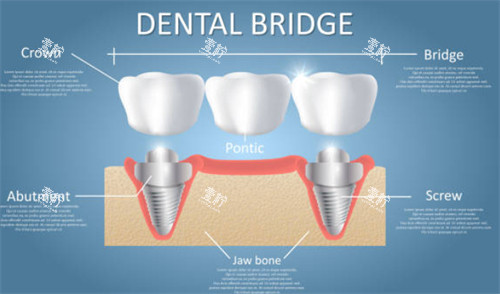 种植牙连桥冠示意图