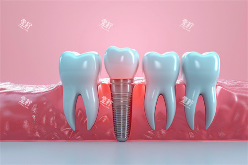 种植牙漫画模型解剖图