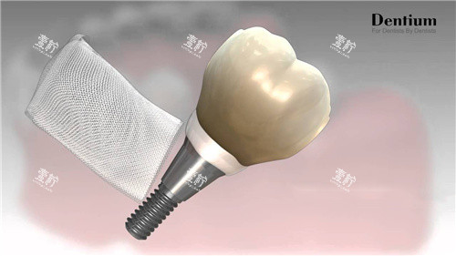 登腾种植牙和骨膜