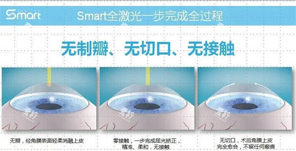 smart全激光手术过程图