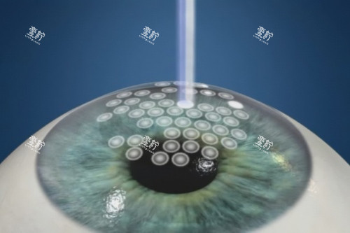 近视党必看！深圳黑马眼科Smart全激光适合哪些人做？