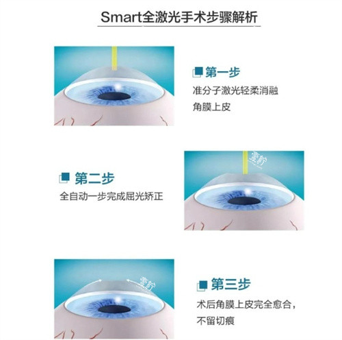 全激光smart手术步骤