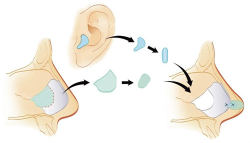 耳软骨隆鼻流程图