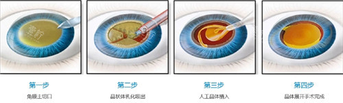 白内障手术过程图