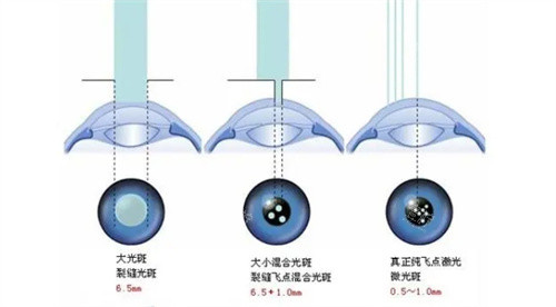 近视眼视光图