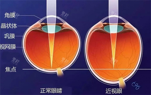 近视眼和正常眼对比图