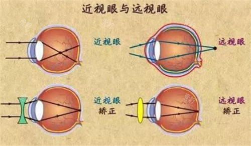 近视眼与远视眼的不同图解