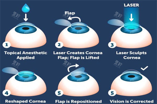激光治疗近视眼动画图